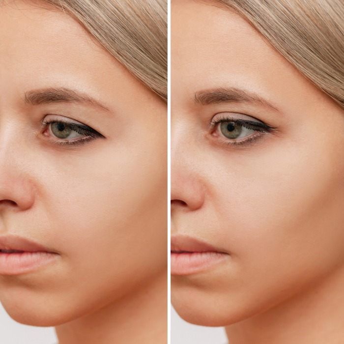 YouthRx Instant EyeLift before and after