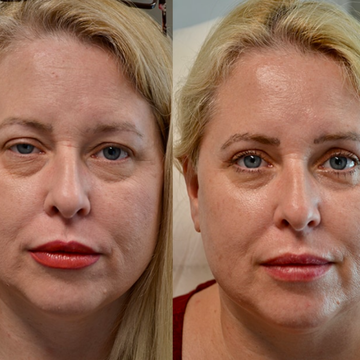 YouthRx Instant EyeLift before and after