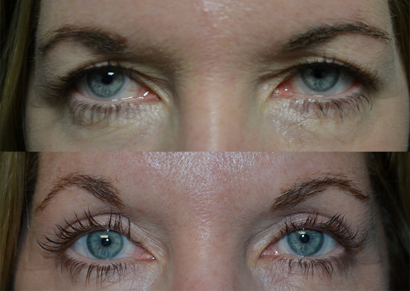 YouthRx Instant EyeLift testimonial