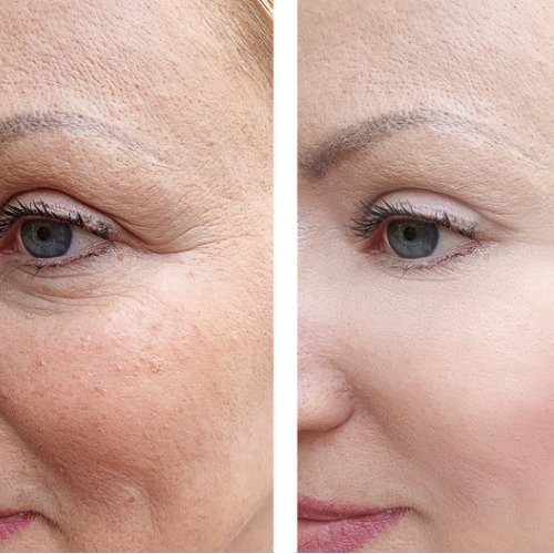 YouthRx Instant EyeLift before and after